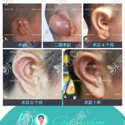 耳朵畸形整形手术多少钱？耳朵取米手术多少钱
