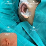 耳朵畸形整形手术多少钱？耳朵取米手术多少钱