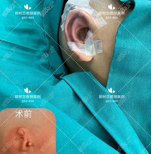 耳朵畸形整形手术多少钱？耳朵取米手术多少钱  第3张